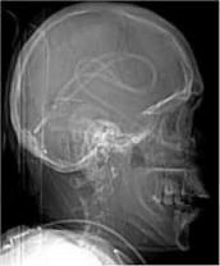 Side skull X-ray showing coiled intracranial tubing and teeth, medical pics