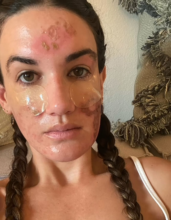 Woman with facial skin damage and patches, highlighting permanent disfigurement after celebrity facialist treatment claims. Woman with facial skin damage and patches, highlighting permanent disfigurement after celebrity facialist treatment claims.