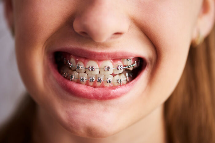 Close-up of a child’s smile with braces, highlighting dental care and challenges faced by autistic kids at the dentist. Close-up of a child’s smile with braces, highlighting dental care and challenges faced by autistic kids at the dentist.