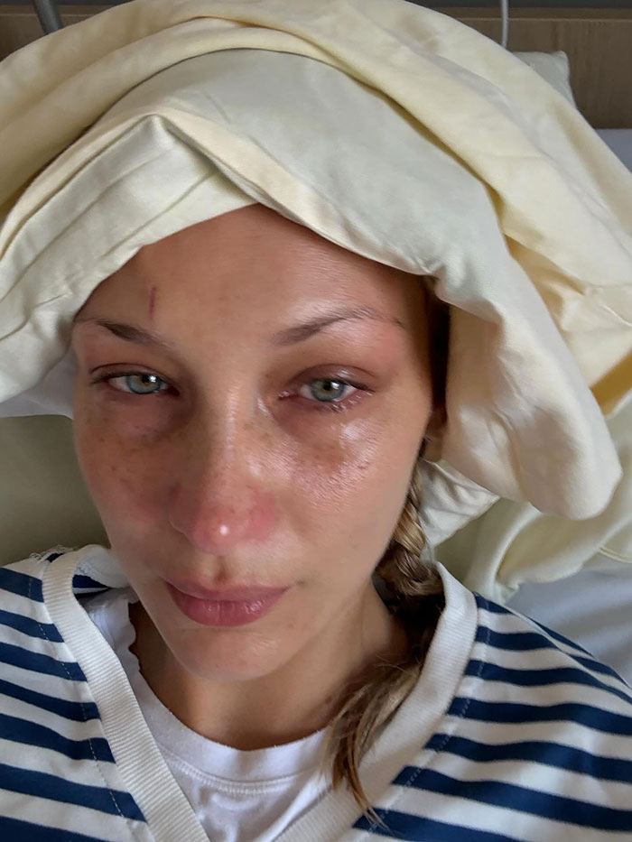 Close-up of Bella Hadid in hospital bed with tired eyes and a blanket wrapped around her head after revealing invisible suffering. Close-up of Bella Hadid in hospital bed with tired eyes and a blanket wrapped around her head after revealing invisible suffering.