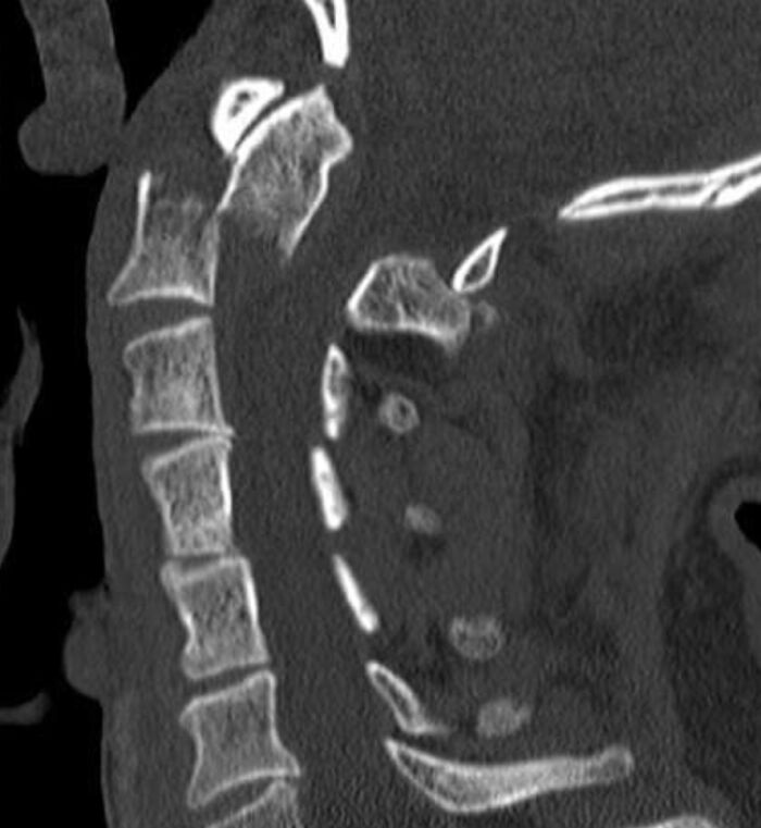 CT scan image of spinal bones showing unusual medical condition in patients who defied medical odds according to doctors
