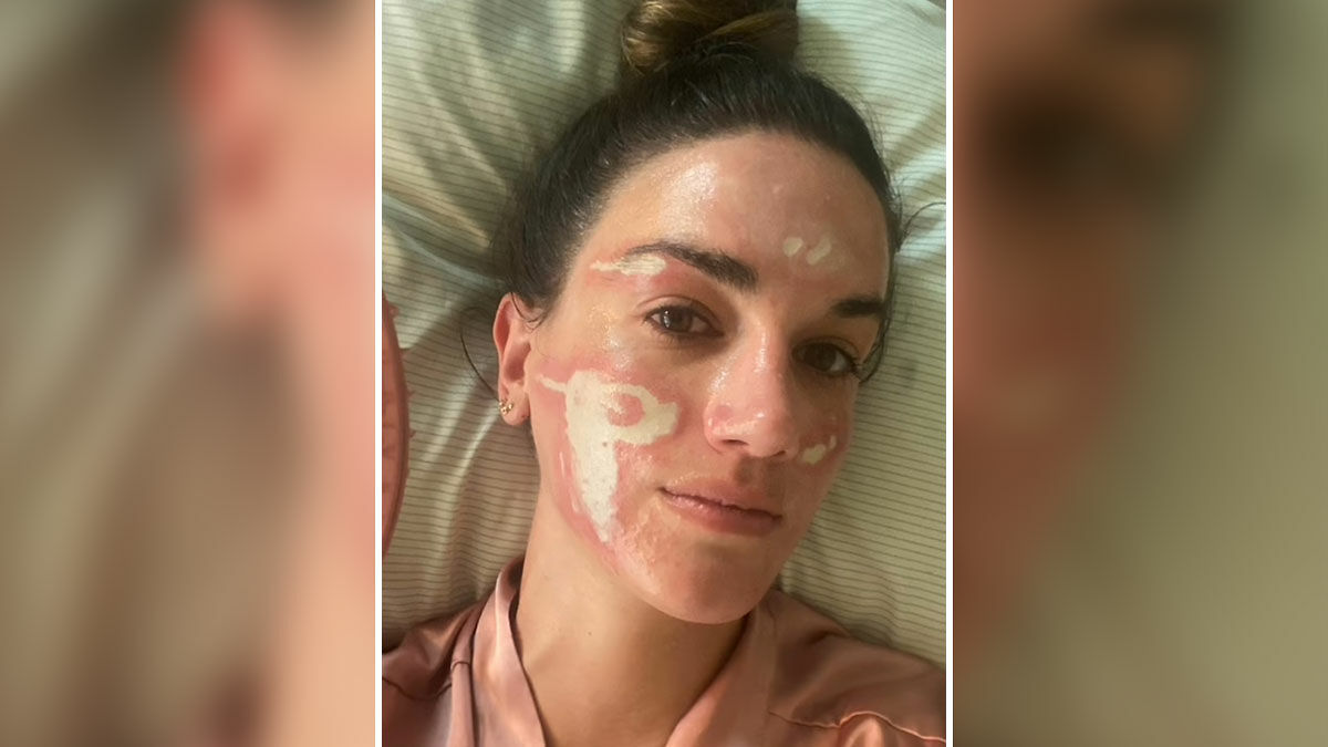 Woman with facial scars and discoloration after treatment by celebrity facialist claiming permanent disfigurement and expensive repairs.