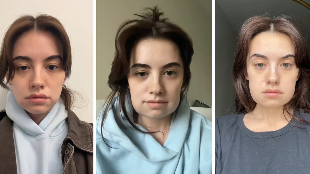 Young woman showing Kybella face transformation in three stages during her extreme recovery phase at home.