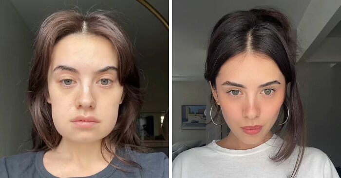 Woman’s ‘Kybella’ Face Transformation Stuns People After Her Extreme Recovery Phase Goes Viral