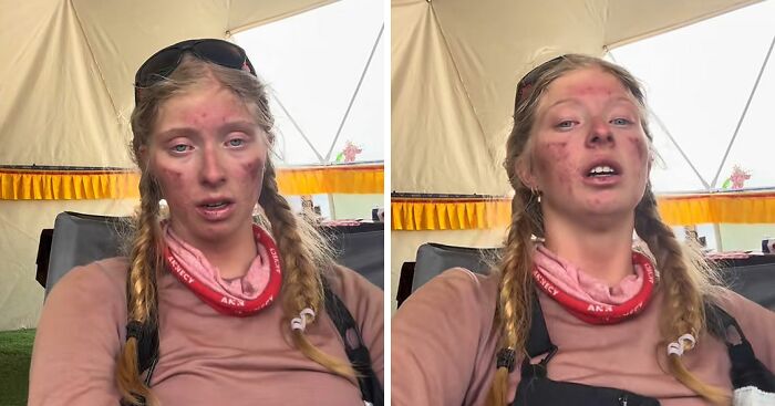 Severely Injured After Everest Climb, 17YO Teen Sparks Online Debate: “Why Take The Risk?”