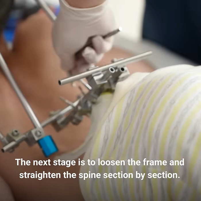 Close-up of a medical device adjusting the spine of a folded boy to help straighten his posture gradually. Close-up of a medical device adjusting the spine of a folded boy to help straighten his posture gradually.