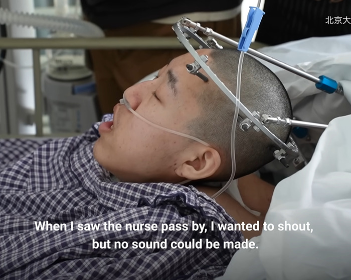 Boy with medical head frame receiving treatment after being bent at 180 degrees finally stands up straight. Boy with medical head frame receiving treatment after being bent at 180 degrees finally stands up straight.