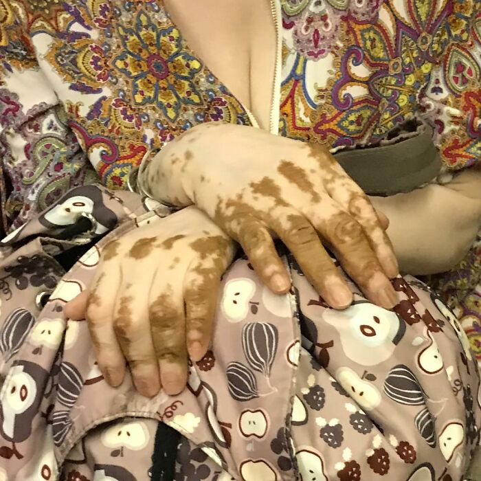 Person with vitiligo holding a patterned bag while riding the subway in New York carrying unique items in their hands