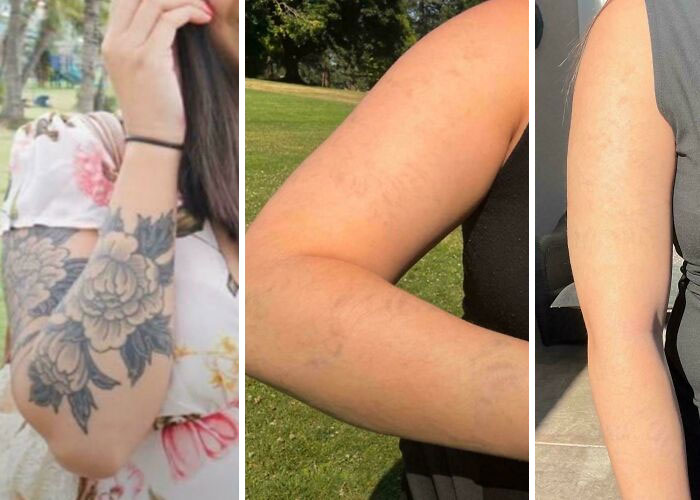 Before and after photos showing tattoo mistakes fading and skin healing, highlighting tattoo correction progress on arms.