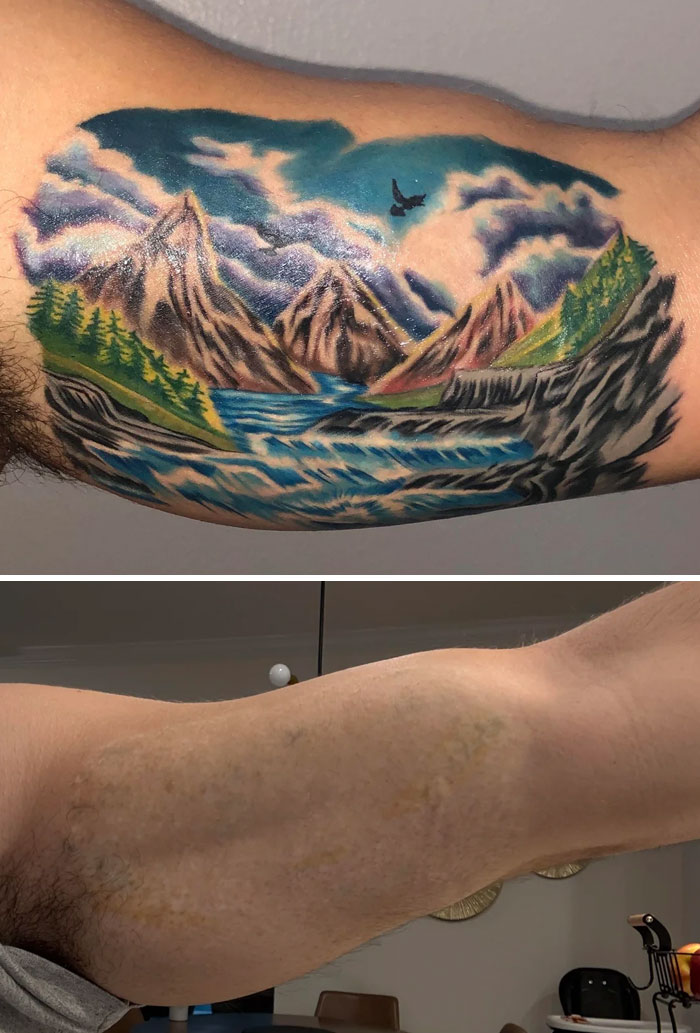 Detailed mountain and river tattoo on arm before removal and bare arm after, showing tattoo mistakes are not permanent