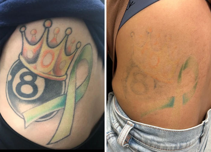 Tattoo before and after photos showing faded ink and correction of tattoo mistakes on a person's side skin.
