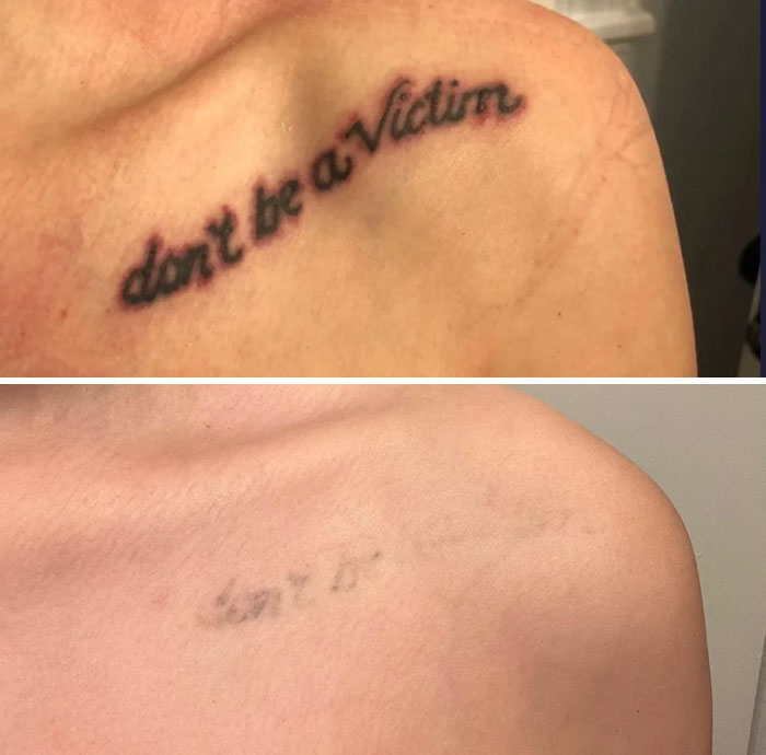 Faded tattoo removal on shoulder showing how tattoo mistakes aren’t permanent with before and after results.