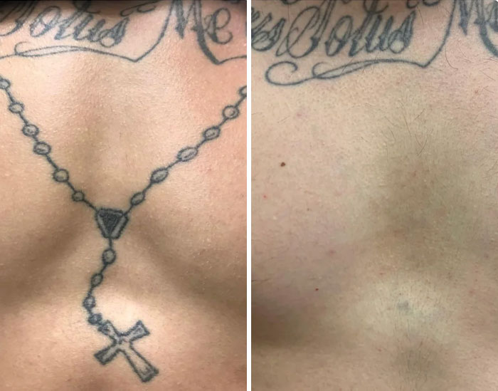 Before and after photos showing tattoo mistake removal with clear skin and no visible ink residue.