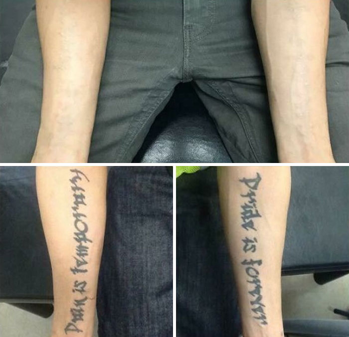 Before and after photos showing tattoo mistakes removed from forearms, highlighting advances in tattoo correction.