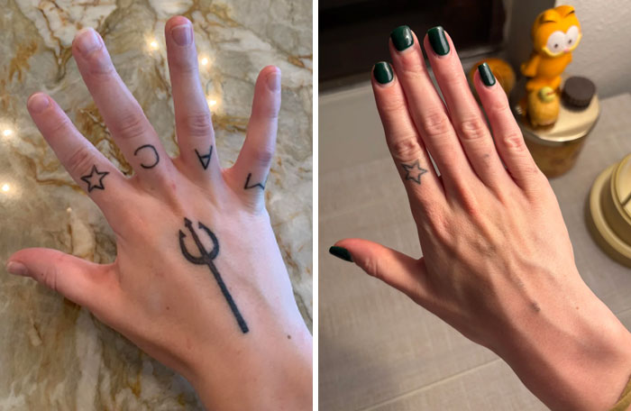 Before and after photos showing tattoo mistake removal on fingers with improved skin and minimal ink remnants.