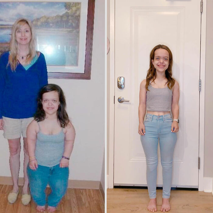 31YO woman with dwarfism before and after height surgery, showing stunning transformation and increased height standing indoors. 31YO woman with dwarfism before and after height surgery, showing stunning transformation and increased height standing indoors.