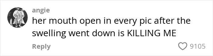 Comment about woman’s Kybella face transformation mentioning her mouth open after swelling reduction in viral recovery phase. Comment about woman’s Kybella face transformation mentioning her mouth open after swelling reduction in viral recovery phase.