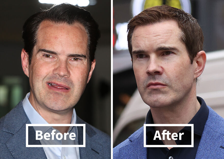 Side-by-side before and after images of a Jimmy Carr showing results of hair transplant transformation.