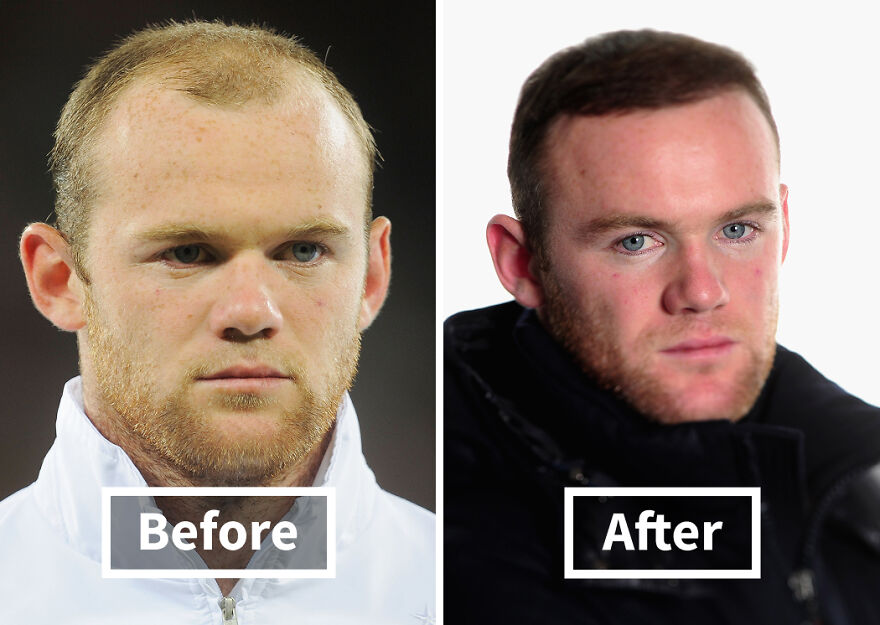 Side-by-side before and after images of a Wayne Rooney showing results of hair transplant with noticeable hair restoration.
