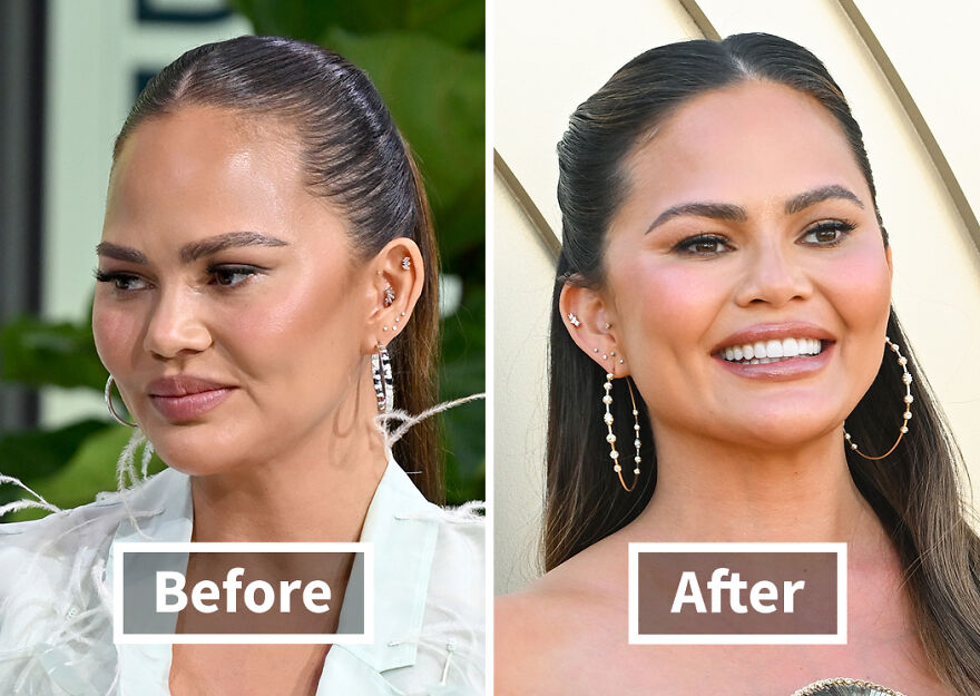 Side-by-side before and after photos of a Chrissy Teigen showing results of hair transplant transformation.