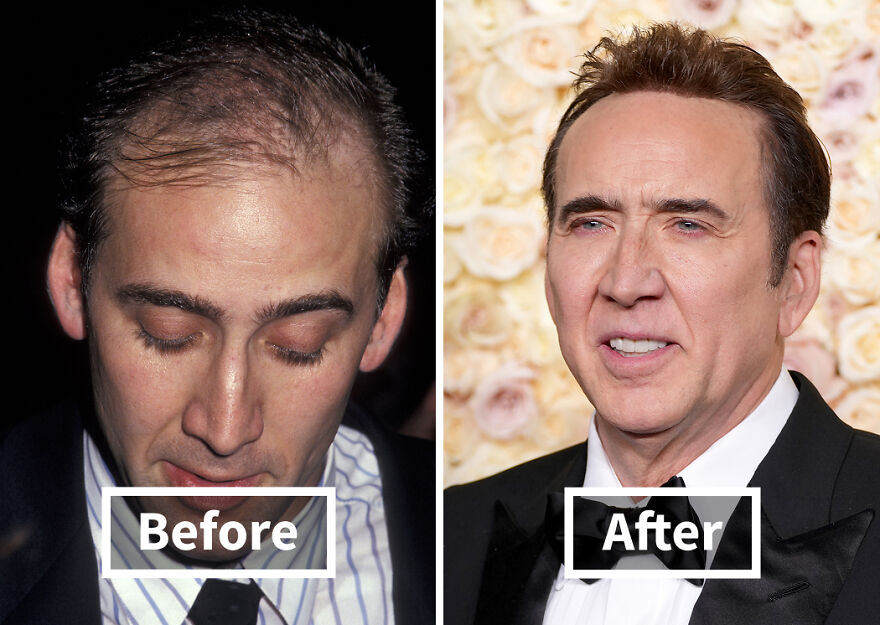 Before and after photos of a Nicolas Cage showing the dramatic results of hair transplants and improved hair growth.