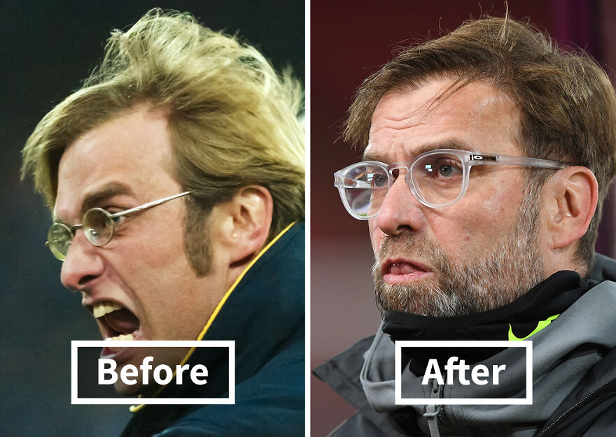 Side-by-side comparison of a Jürgen Klopp before and after hair transplant showing dramatic hair restoration results.