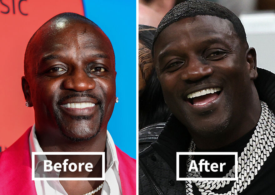Before and after images of a Akon showing hair transplant results with a fuller hairline and improved appearance.
