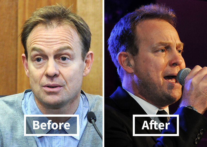 Side-by-side photos of a Jason Donovan before and after hair transplant showing a fuller hairline and improved appearance.