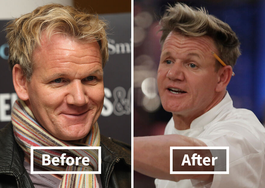 Before and after photos of a Gordon Ramsay showcasing the results of hair transplants with a noticeable hair transformation.