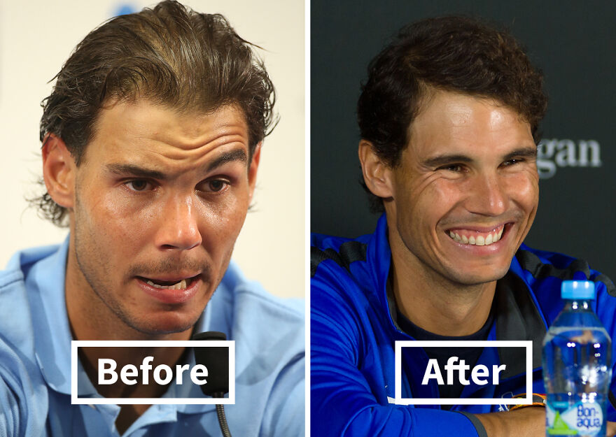 Rafael Nadal before and after hair transplant, showing a noticeable difference in hair density and style.