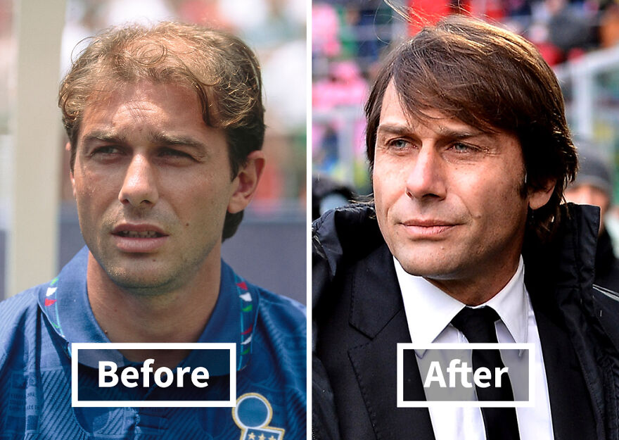 Side-by-side before and after photos of a Antonio Conte showcasing hair transplant results, hair transplants transformation.