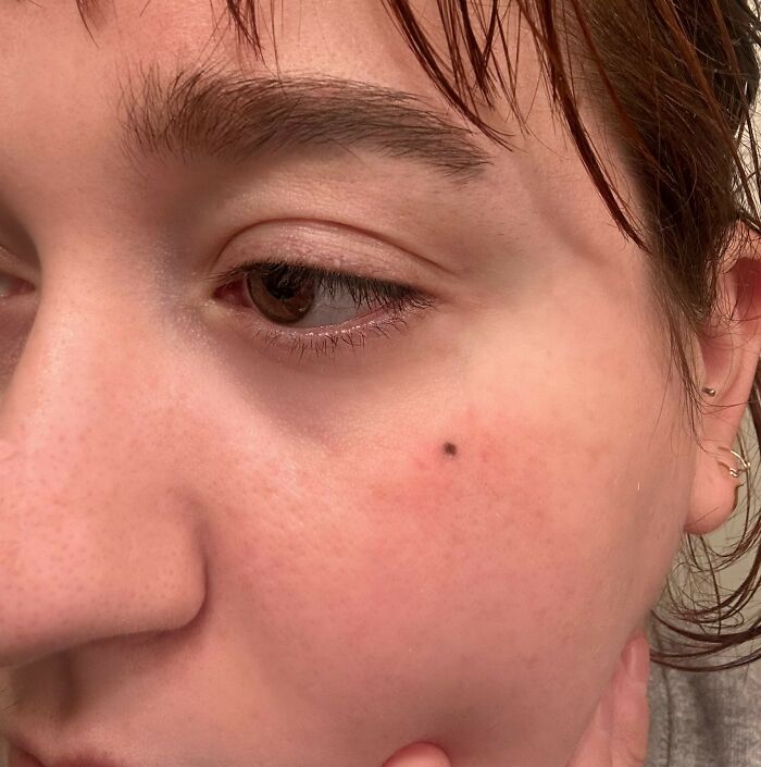 Close-up of a person's face with clear skin and a small mole, illustrating tattoo artists refused to ink unusual spots.