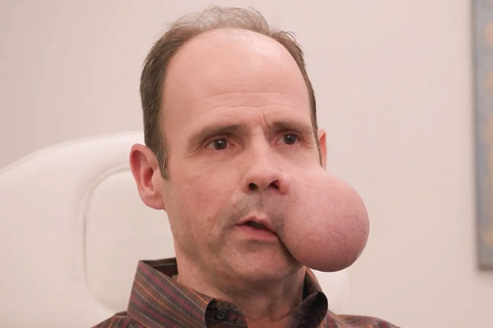 Man with large 4-lb face tumor sitting indoors, seeking urgent medical help as doctor issues fatal warning. Man with large 4-lb face tumor sitting indoors, seeking urgent medical help as doctor issues fatal warning.