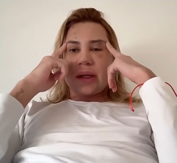 Influencer with visible facial marks discussing complications from popular fox eyes surgery in a casual indoor setting. Influencer with visible facial marks discussing complications from popular fox eyes surgery in a casual indoor setting.