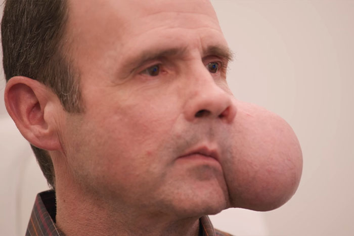 Man with large 4-lb face tumor on cheek urgently seeking medical help amid fatal doctor warning. Man with large 4-lb face tumor on cheek urgently seeking medical help amid fatal doctor warning.