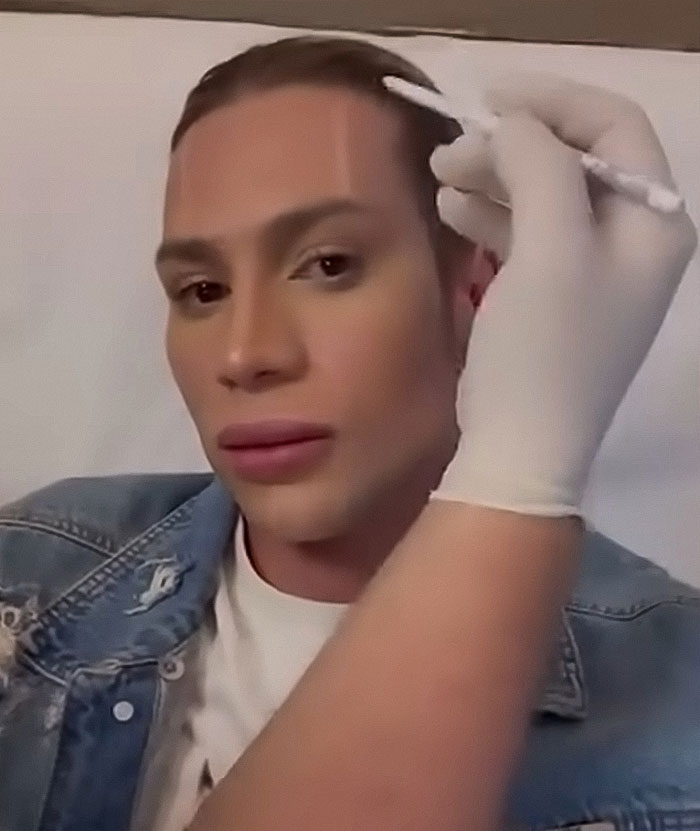 Influencer receiving cosmetic procedure, highlighting risks and complications from popular Fox Eyes surgery trend. Influencer receiving cosmetic procedure, highlighting risks and complications from popular Fox Eyes surgery trend.