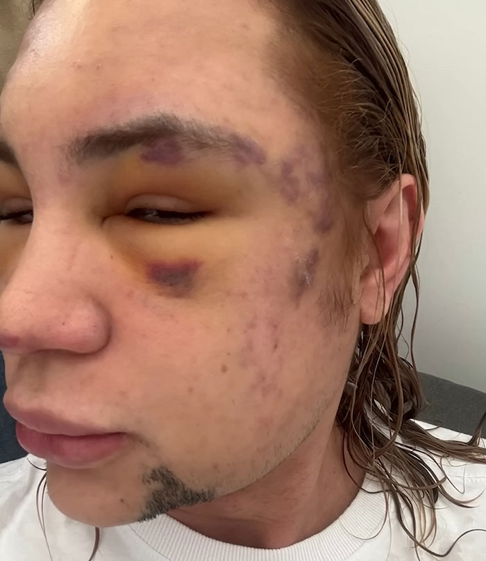 Close-up of a person’s bruised face showing complications from popular fox eyes surgery aftereffects. Close-up of a person’s bruised face showing complications from popular fox eyes surgery aftereffects.