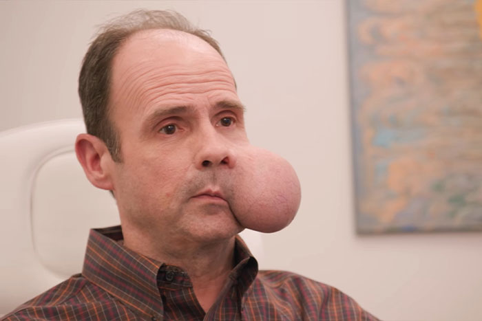 Man with a large 4-lb face tumor sitting indoors seeking urgent medical help amid a fatal doctor warning. Man with a large 4-lb face tumor sitting indoors seeking urgent medical help amid a fatal doctor warning.