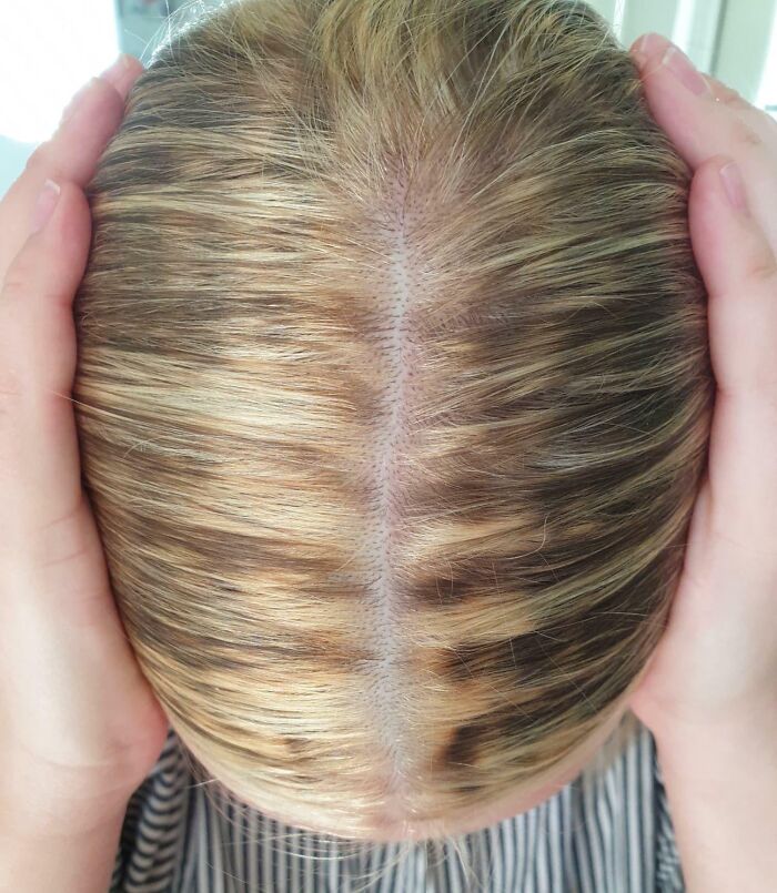 Close-up of a hair accident showing unevenly dyed hair with hands on the sides, highlighting a tragic hair mishap.
