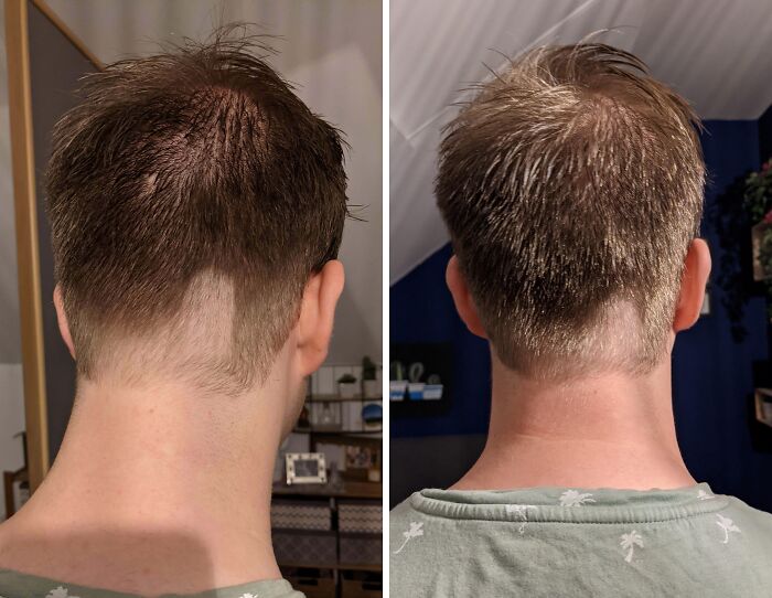 Two photos showing hilariously tragic hair accidents with uneven and patchy haircuts on the back of a person's head.