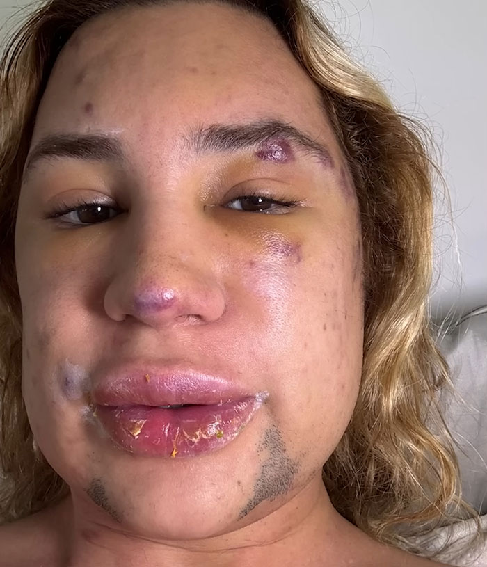 Close-up of a woman showing severe facial wounds and bruising after complications from fox eyes surgery. Close-up of a woman showing severe facial wounds and bruising after complications from fox eyes surgery.