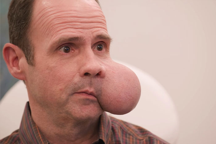 Man with large 4-lb face tumor sitting in medical office seeking urgent help after doctor issues fatal warning. Man with large 4-lb face tumor sitting in medical office seeking urgent help after doctor issues fatal warning.