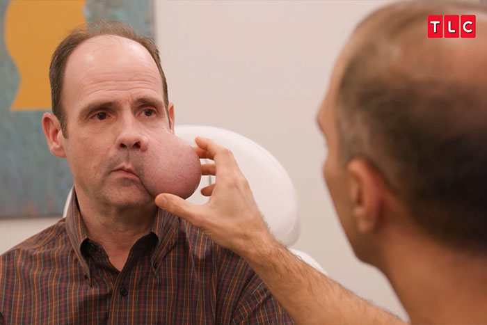 Man with 4-lb face tumor being examined by doctor in medical setting while seeking urgent help for condition. Man with 4-lb face tumor being examined by doctor in medical setting while seeking urgent help for condition.