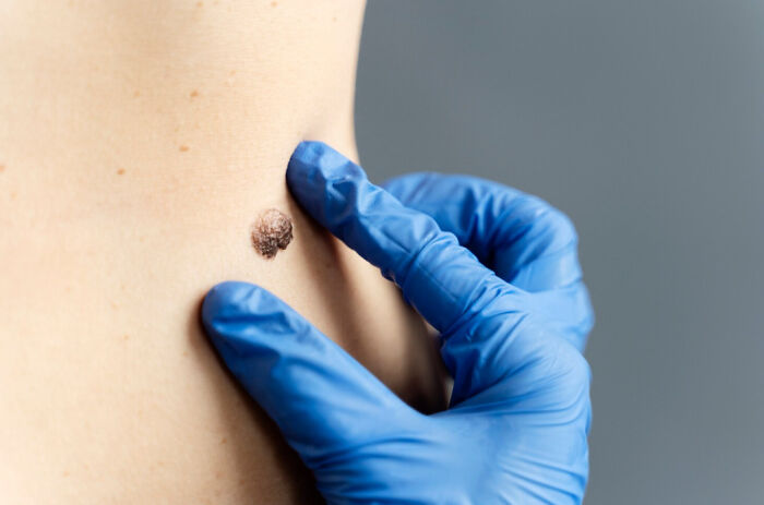 Close-up of a doctor examining a mole on skin, highlighting unexpected symptoms cancer survivors noticed before diagnosis.