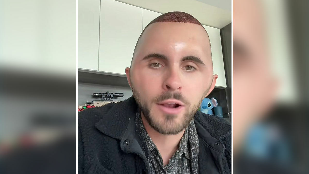 TikToker with red scalp showing hair transplant recovery, wearing black jacket indoors, making a humorous expression.