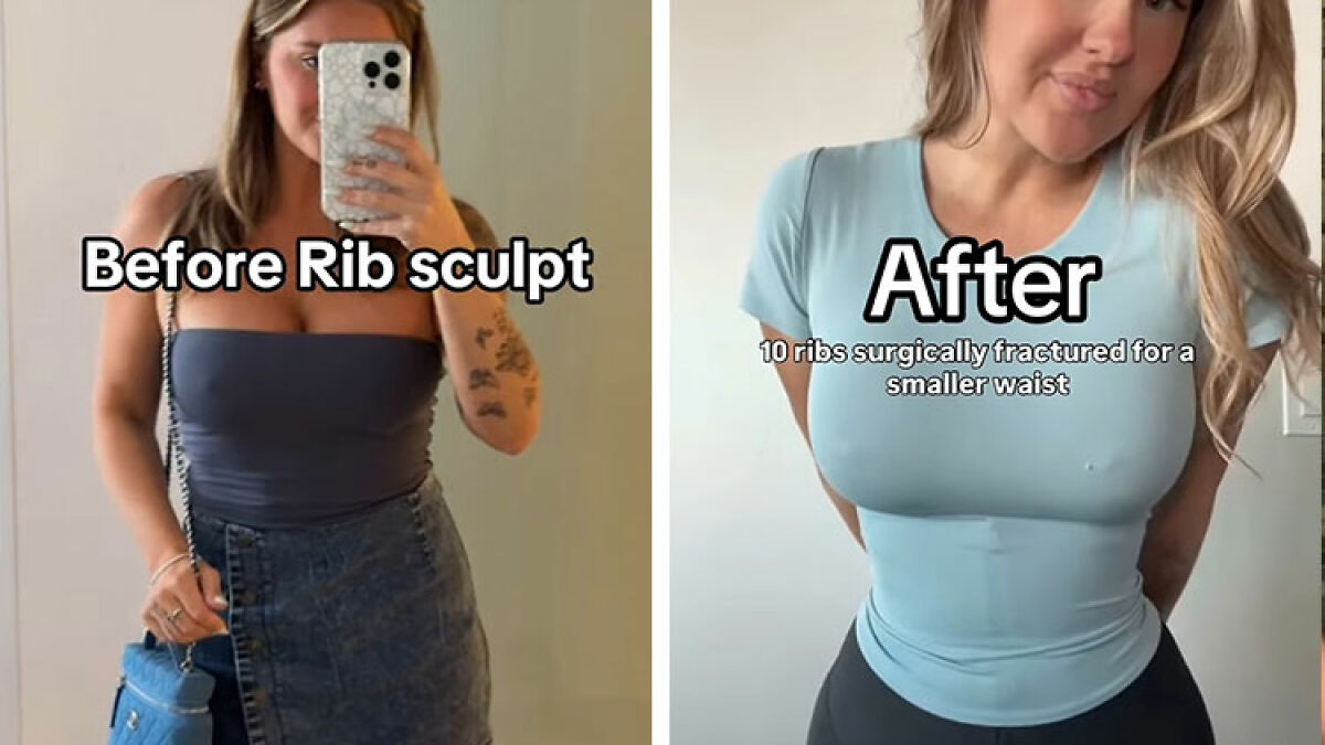 Side-by-side photos showing a mom's rib breaking transformation to achieve a smaller waist in before-and-after clips.