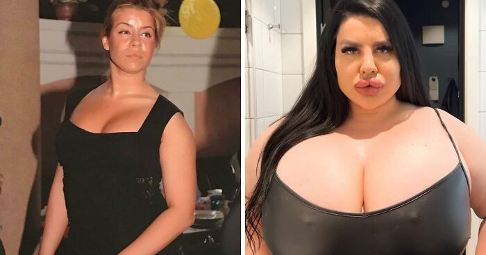 Plastic Surgery Enthusiast Who Paid $148k For 5 BBLs Shocks The Internet With Her ‘Before’ Photos