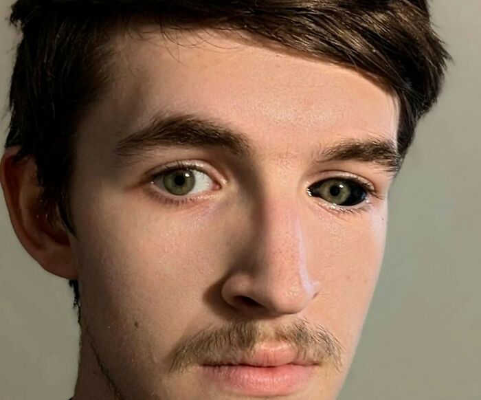 Close-up of a young man with one natural eye and one eye tattooed completely black, showing strange tattoo art refusal.