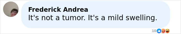 Comment by Frederick Andrea stating it's not a tumor but a mild swelling in a social media post about face tumor help. Comment by Frederick Andrea stating it's not a tumor but a mild swelling in a social media post about face tumor help.