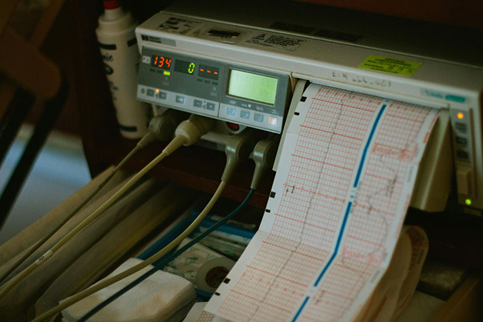 Hospital heart monitor displaying vital signs and printed cardiac data during unexpected surgery cases.